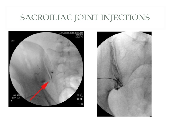 sacroiliac joint injection
